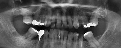 Why Do I Need X-rays of My Teeth?