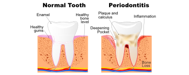 Health Risks Related to Peridontal Disease